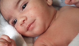 Isaiah, a Nemours patient with pertussis (whopping cough)